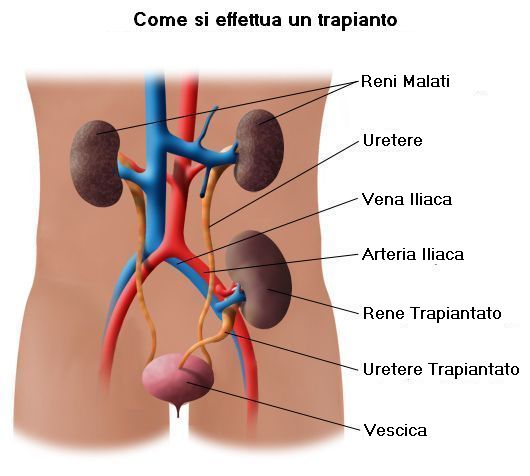 Trapianto